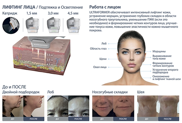 Смас лифтинг ультраформер фото до и после